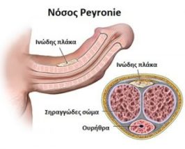 Νόσος Peyronie
